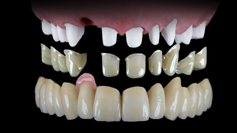 Zirkon-Galvano-Teleskope, Dentallabor Michael Schweiger